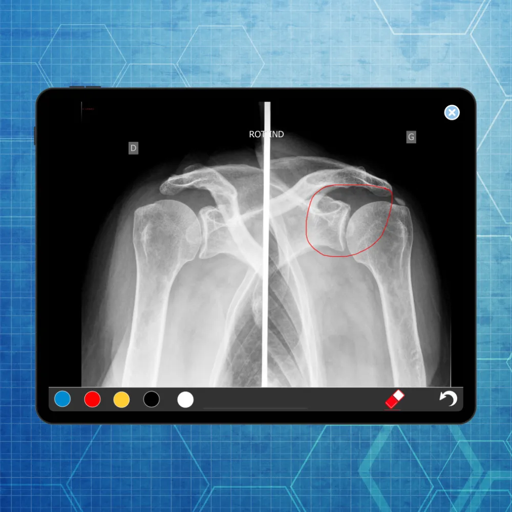 Rheumatoid Arthritis eLearning